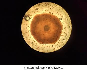 Aureus continues to be a major cause of mortality and is responsible for a variety of infections including, boils. Imagens, fotos stock e imagens vetoriais de Staphylococcus ...