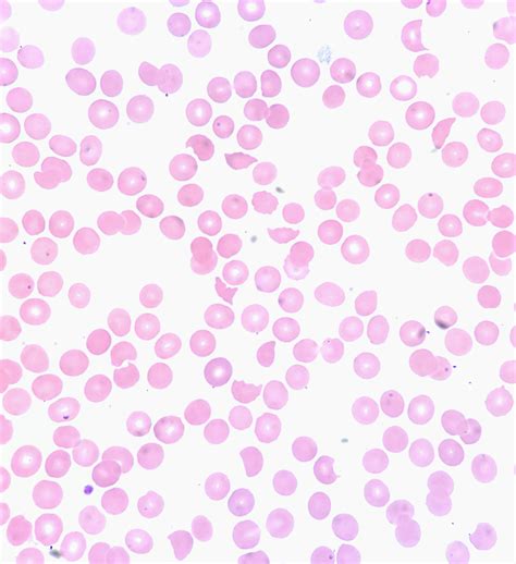 Microangiopathic Hemolytic Anemia Peripheral Blood Smear