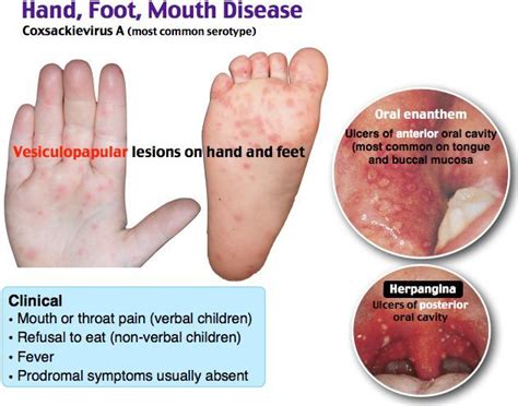 Hand Foot Mouth Disease Coxsackievirus A Rosh Review Dermatology