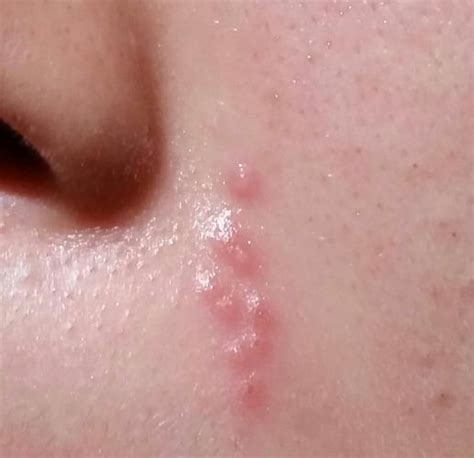 List 90 Pictures Herpes On Inside Of Lip Pictures Completed