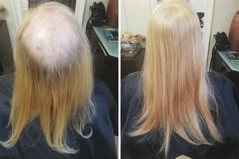 Best Hair Extensions For Balding Crowns And How To Attach Ph
