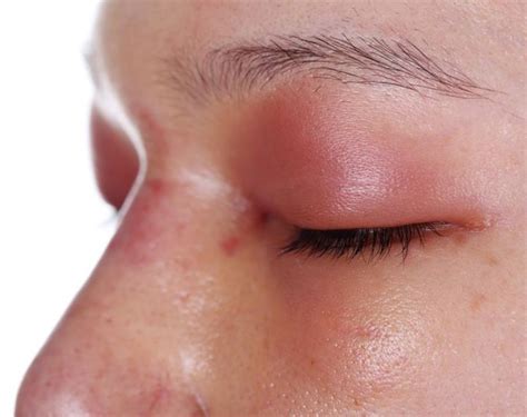 An Allergic Reaction That Causes The Eyes To Swell Livestrongcom