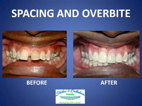 Braces Before And After Overbite Before And After