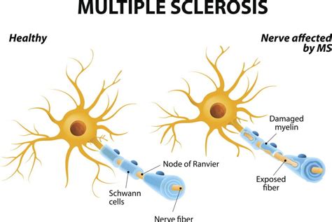 Top 20 Home Remedies And Natural Treatments For Multiple Sclerosis