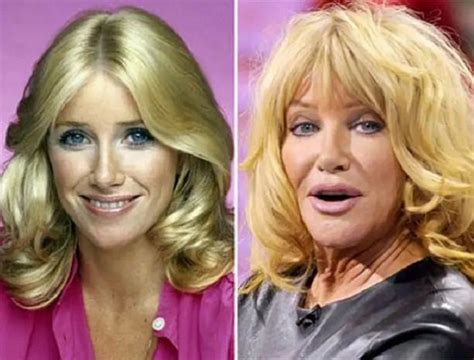Suzanne Somers Before And After Plastic Surgery Boob Nose Facelift