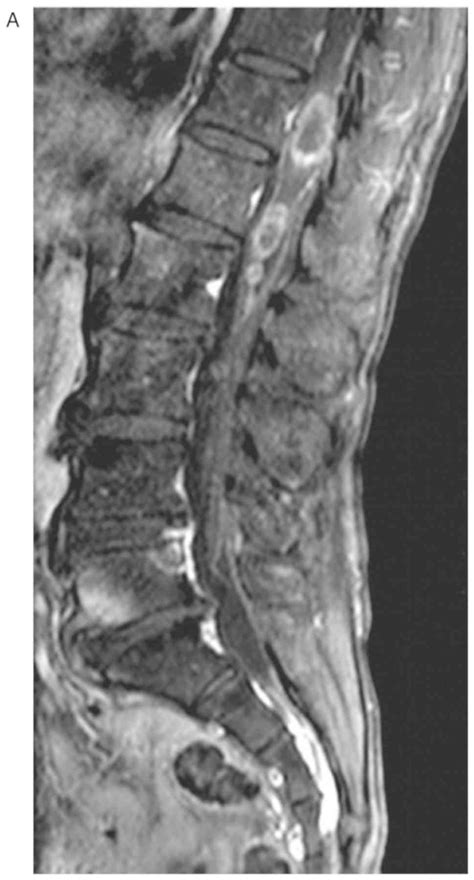 Case Report Conus Medullaris Syndrome From Spinal
