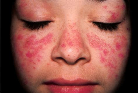 In current usage when the word is used alone, it has no precise meaning' (taber, 1273). Picture of Systemic Lupus Erythematosus