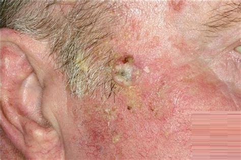 What Is Actinic Keratosis And How To Treat It Be Beautiful India My