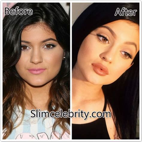 Kylie Jenner Lips0 Kylie Jenner Lip Injections Kylie Jenner Lips Lip
