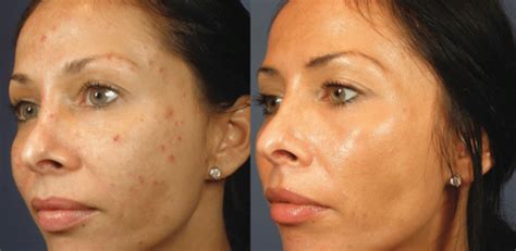 Vi Peels Improve Skin Tone Texture And Radiance Evolvmd