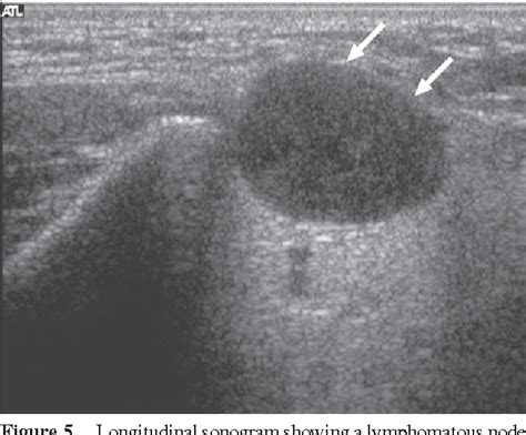 Figure 5 From Ultrasonography Of Neck Lymph Nodes In Children