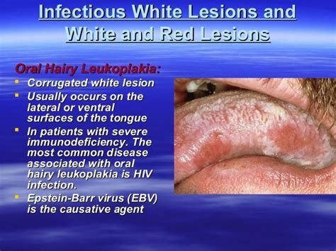 White Lesions Ppt