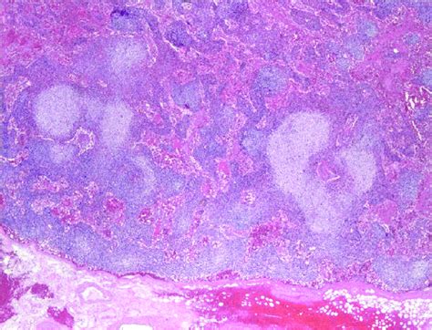 Axillary Lymph Node Biopsy Showing Reactive Follicular Hyperplasia With