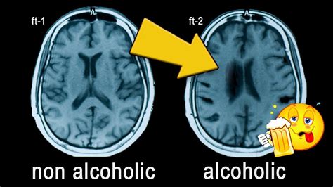 Does Alcohol Kill Brain Cells Debunking A Myth Youtube