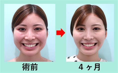 ここまで変わる！ 顔の脂肪吸引 バッカルファット除去 東京・銀座の美容外科クリニック｜wom Clinic Ginza