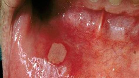 Hiv Mouth Sores What They Look Like And How To Treat Them