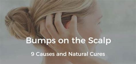 Bumps On Scalp 9 Causes And Natural Treatments Daily Health Cures