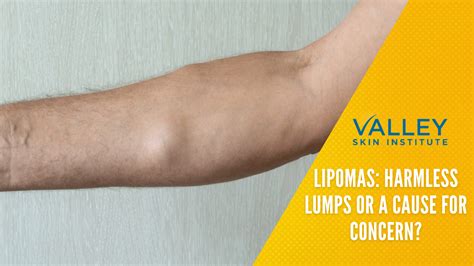 Lipomas Causes Symptoms Diagnosis And Treatment