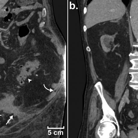 Admission Ct Images Demonstrating The Abscess Forming A Sinus Tract