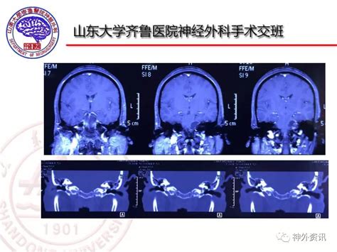 乙状窦后入路无血快速开关颅技术标准化操作流程（sop） 脑医汇 神外资讯 神介资讯