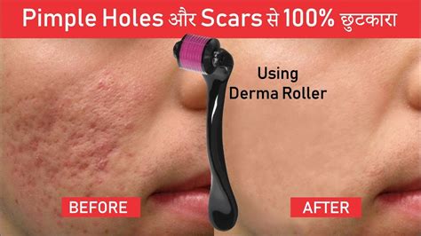 Pimple Holes And Scars Treatment Using Derma Roller Result