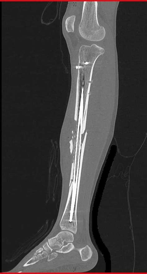 Open Reduction Internal Fixation Orif Of Tibia And Fibular Fractures