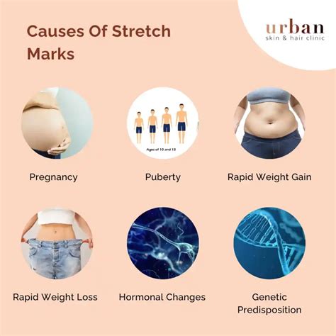 Stretch Marks Types Causes Symptoms And Treatment Ushc