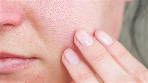 The Real Difference Between Blackheads And Sebaceous Filaments