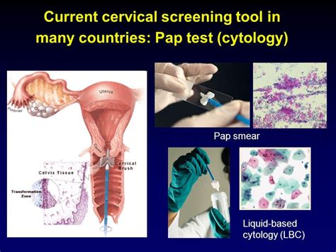 All About Cervical Cancer Causes Symptoms Diagnosis Treatment And