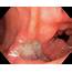 Prepyloric Stomach Ulcer Photograph By Gastrolab