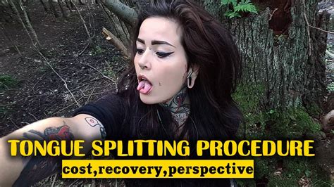 Tongue Splitting Procedure Cost Recovery Perspective Youtube
