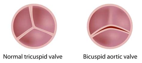Bicuspid Aortic Valve Symptoms Diagnosis Treatment And Surgery