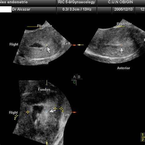 Tomographic Ultrasound Imaging Tui That Depicts The Coronal Plane Of