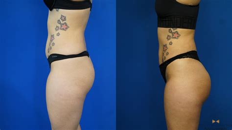 Before And After Pictures Of Brazilian Butt Lift Houston Tx Patch