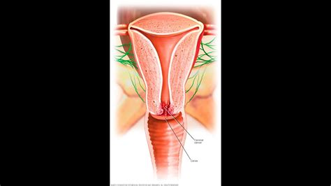 If you're experiencing lower back pain then this could be a sign of cervical. CERVICAL CANCER ( Answering 7 questions on Cervical Cancer ...