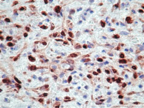 P63 ×100 The Tumor Cell Nuclei Stain Strongly With The