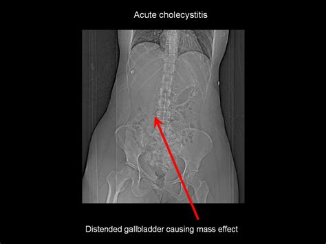 If untreated, acute cholecystitis can lead to: On Call Radiology - common radiology findings on call and ...