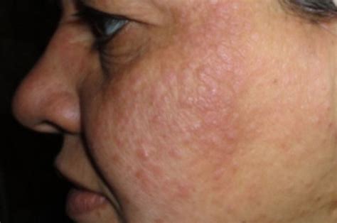 Home Remedies To Treat Rashes On The Face I Dont Have To Worry About