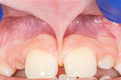 Frenectomy Michigan Implants And Periodontics