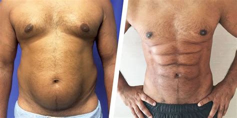Plastic Surgeons Use Abdominal Etching To Create Six Pack