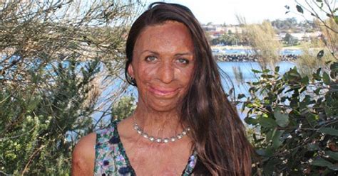 Turia Pitt Opens Up About Her Nose Reconstruction Surgery Honey