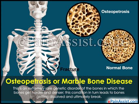 Osteopetrosis Or Marble Bone Disease Treatment Causes
