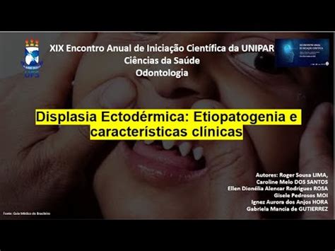Displasia Ectod Rmica Etiopatogenia E Caracter Sticas Cl Nicas Youtube