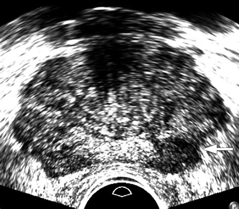 Role Of Transrectal Ultrasonography In Prostate Cancer Radiologic Clinics