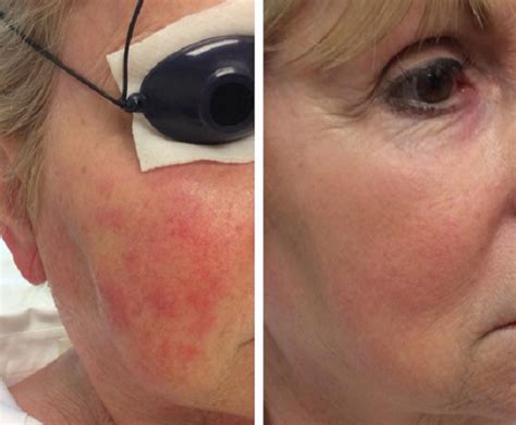ipl light treatment before and after photos lisa bunin md