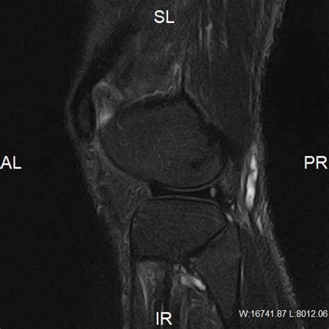 Intraneural Synovial Cyst Of The Common Peroneal Nerve Mri Image