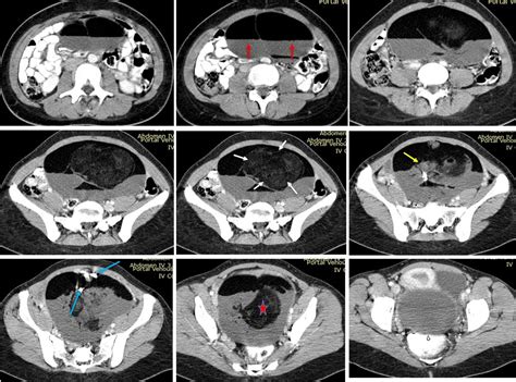 Rokitansky Nodule Radiology Cases