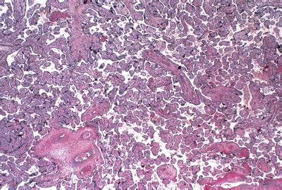 It plays critical roles in facilitating nutrient, gas and waste exchange between the physically separate maternal and fetal circulations. Placenta - Stock Image - P616/0332 - Science Photo Library