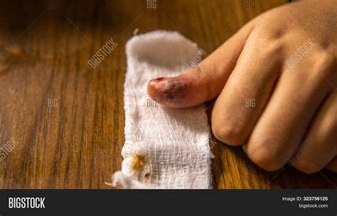 Infection Wound Pus Image And Photo Free Trial Bigstock