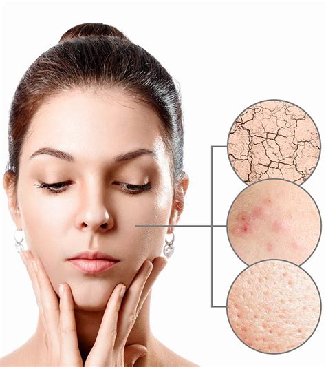 Homemade Remedies For Acne Overnight These Remedies Are What Have